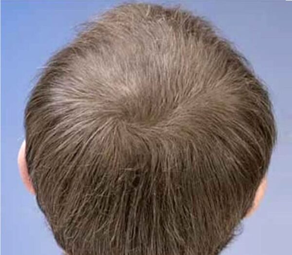 Profolan : Hair Regrowth Solution for men - Image 3